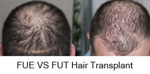 fue-vs-fut-hair-transplant