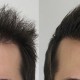 hair restoration Techniques