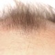 How many grafts do u need for hair transplant