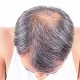 PRP Therapy for Hair Restoration