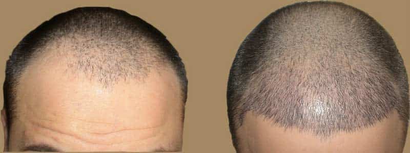 Solution for Hair Loss