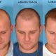 Cost of a hair transplant