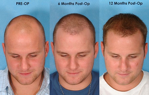 Cost of a hair transplant