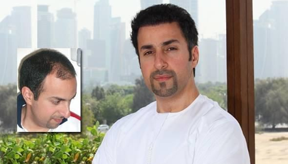 Hair Fixing and Transplant in Dubai