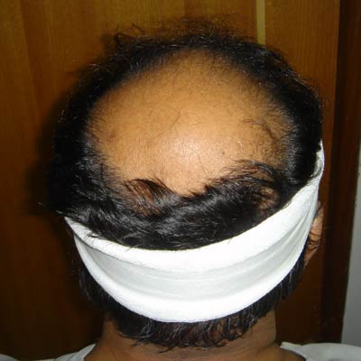 Hair-transplant-in-dubai