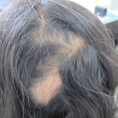 ACell therapy for Hair Restoration