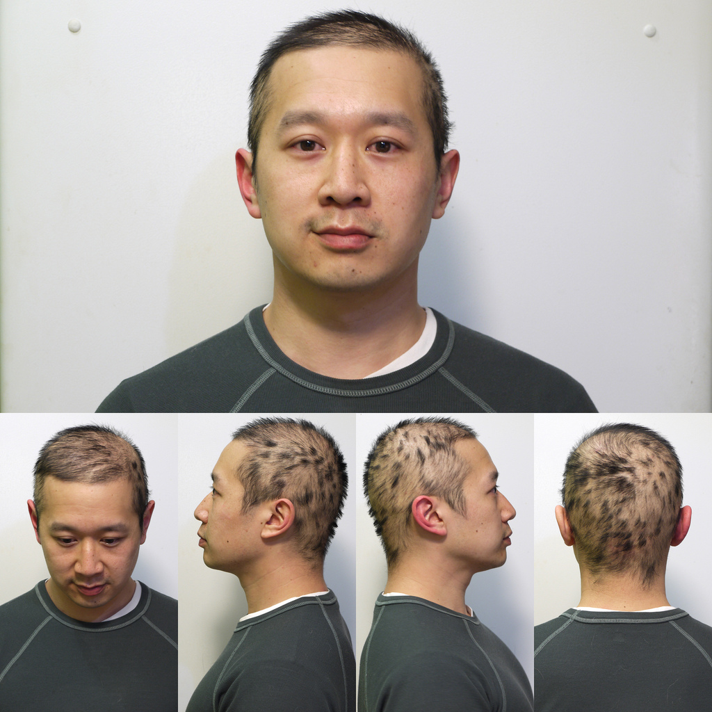 Treatment of Hair Loss