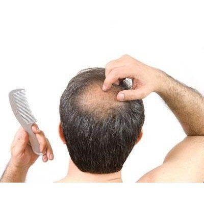hair-loss-in-men